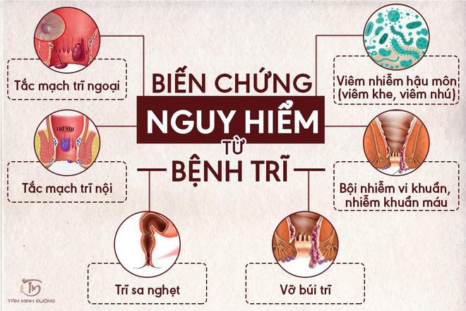 Bệnh trĩ là gì? Nguyên nhân, triệu chứng và cách điều trị hiệu quả