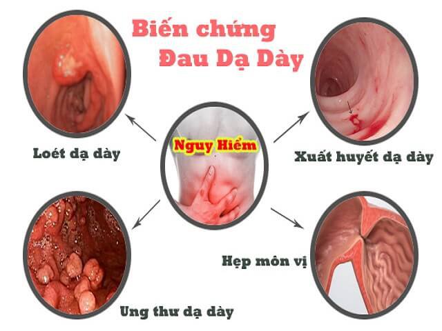 biến chứng dạ dày