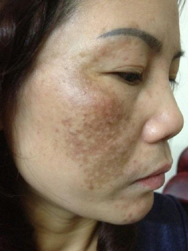 Nguyên nhân gây nám da sau sinh mẹ bầu cần đề phòng