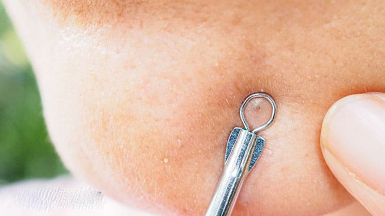 cách trị mụn nhanh nhất ở tuổi dậy thì