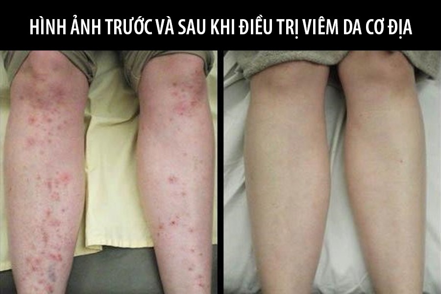 Hình ảnh trước và sau khi dùng Ngưu Bì Giải Độc Ẩm